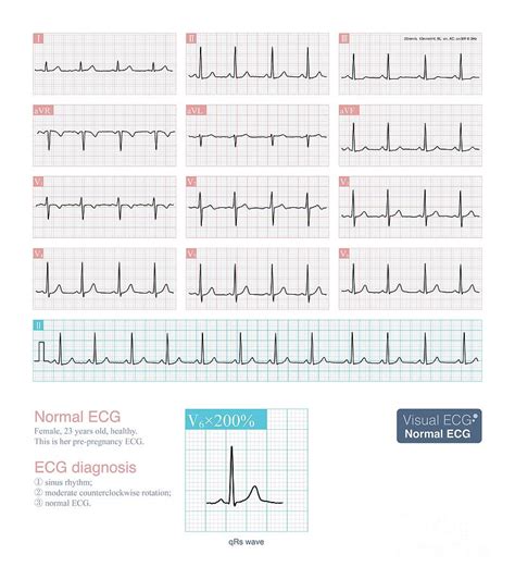 Normal Ecg Photograph by Chongqing Tumi Technology Ltd/science Photo Library | Pixels