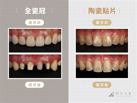 陶瓷貼片跟全瓷冠有何不同 牙齒美白要選哪一種 朗日牙醫