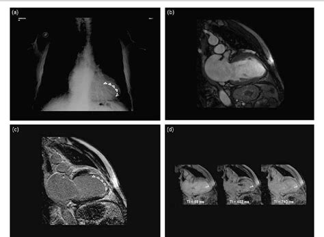 Figure 1 From Calcified Anterior Myocardial Infarction Depicted By Cardiac Mri Semantic Scholar