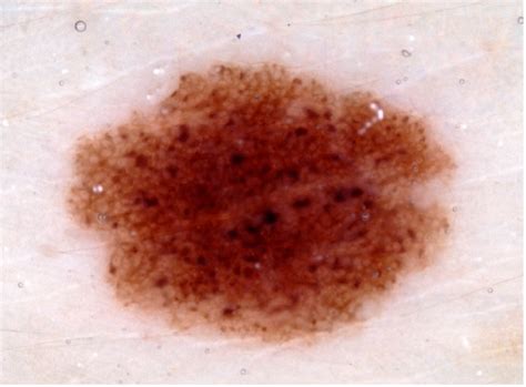 Example Of A Histologically Confirmed Melanocytic Nevus In A