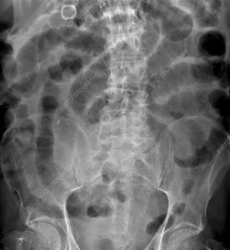 Ileus X Ray