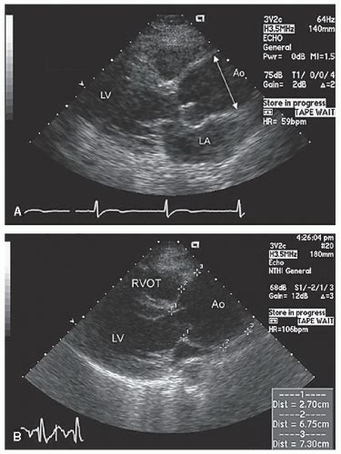 Diseases Of The Aorta Thoracic Key