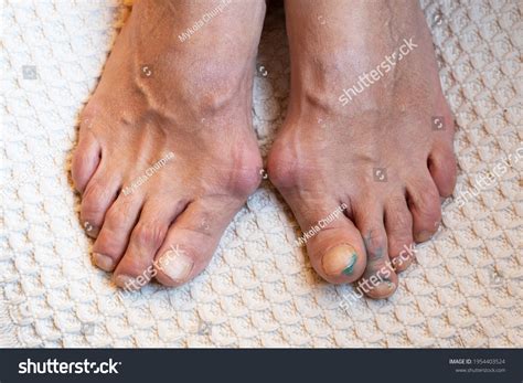 Painful Gout Inflammation On Toe Joints Stock Photo Edit Now 1954403524