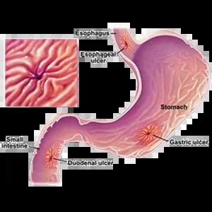 Foods & Gastro-Duodenal Ulcer | Healthreee