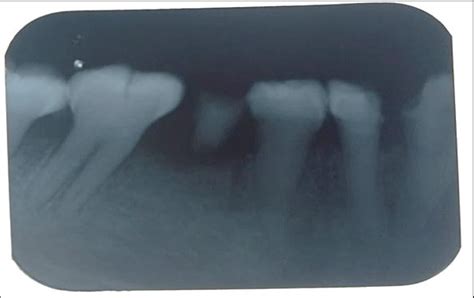 Periapical radiograph showing bulbous crown, cervical constriction,... | Download Scientific Diagram