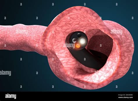 Colonoscopy Hi Res Stock Photography And Images Alamy