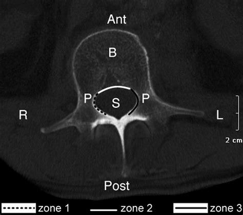 Ct Image In Axial Orientation Showing A Normal Lumbar Vertebra At The