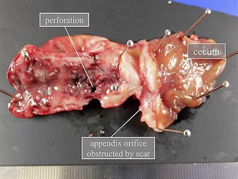 Figure 2 From Acute Appendicitis Caused By Previous Endoscopic