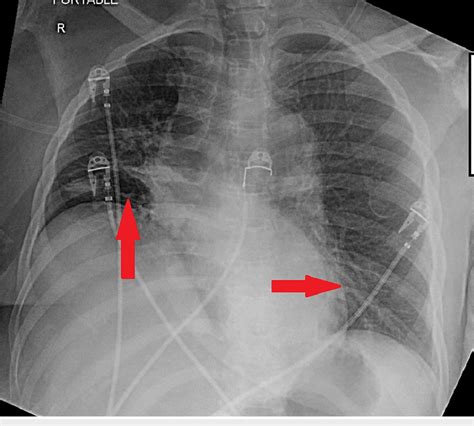 Portable chest radiograph indicating right perihilar, right lower lobe,... | Download Scientific ...