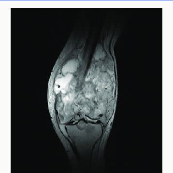 MRI image of the knee joint. Coronal section. | Download Scientific Diagram