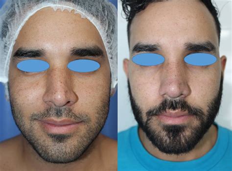 Diferencias Entre Una Rinoplastia Abierta Y Cerrada Clínica Plástica