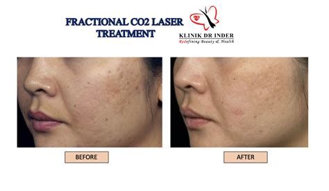 Fractional Co2 Laser Scars Removal Laser Treatment Aesthetic Clinic