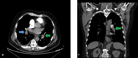 Computed tomography pulmonary angiography images of a 72-year-old male ...