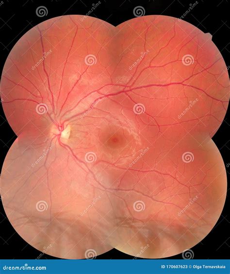 View Inside Human Eye Disorders Showing Retina Optic Nerve And Macula