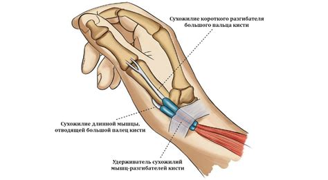 Лечение синдрома де Кервена (теносиновита) в Москве
