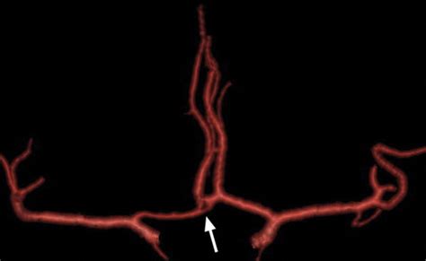 Normal Variants Of The Cerebral Circulation At Multidetector Ct