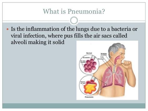 Pneumonia