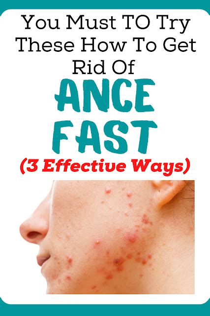 How To Get Rid Of Acne Fast 3 Effective Ways Nutrition Health