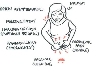 Ectopic Pregnancy Pain Location / Symptoms Of Ectopic Pregnancy Infographics Vector Illustration ...