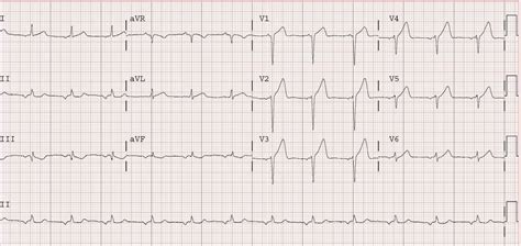 Dr Smiths Ecg Blog Acute Anterior Stemi From Lad Occlusion Or