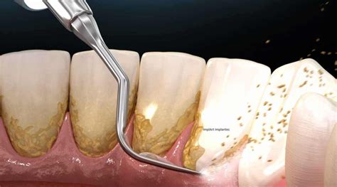 Dente Mole O que é Porque Ocorre Tratamento e Prevenção