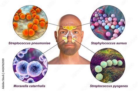 Purulent Inflammation Of Frontal And Maxillary Sinuses In A Man And