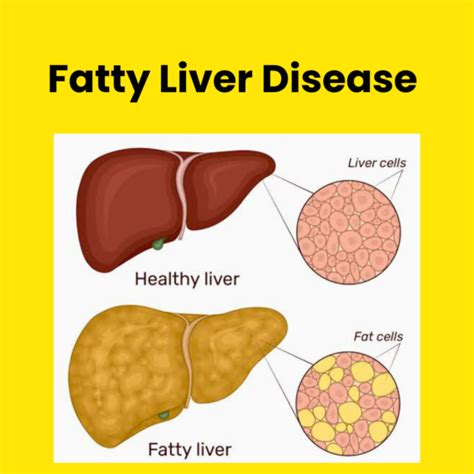 Fatty Liver Disease Causes Symptoms And Treatment