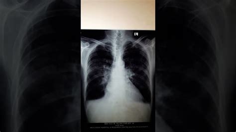 Bat Wing Appearance On Chest X Ray Pulmonary Edema On Chest