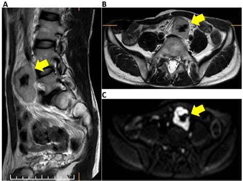 Figure From Surgical Resection For Pelvic Retroperitoneal Castleman S