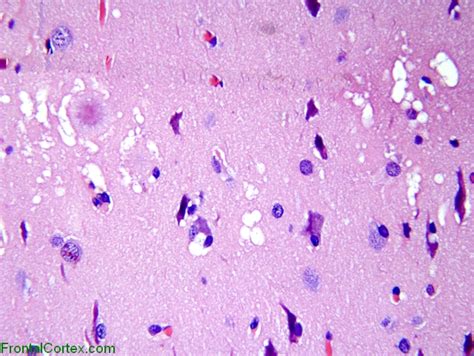 Variant Jakob Creutzfeldt Disease H E Stained Section Of Cerebral