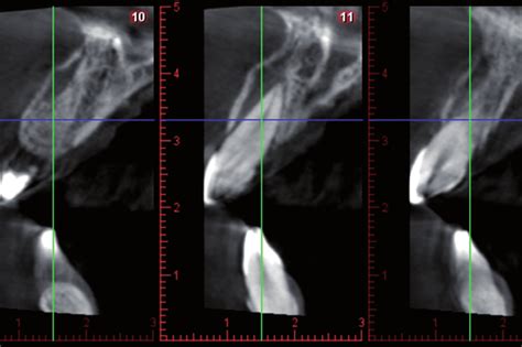 Cbct View Showing Of The Upper Central Incisors Showing The Alveolar