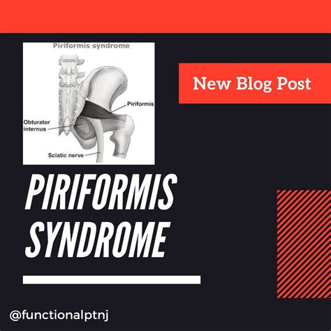 Piriformis Syndrome Pain Pattern