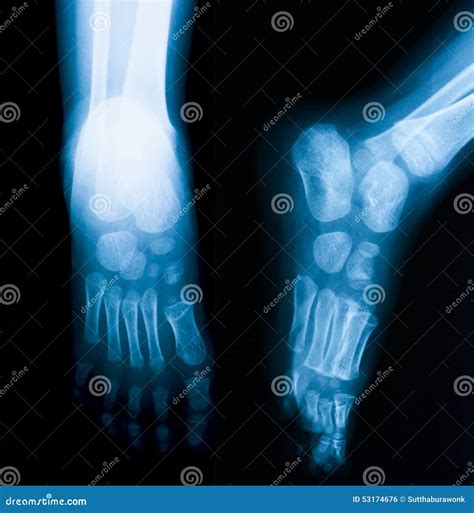 X Ray Image Of Foot Ap And Oblique View Stock Photo Image Of Joint