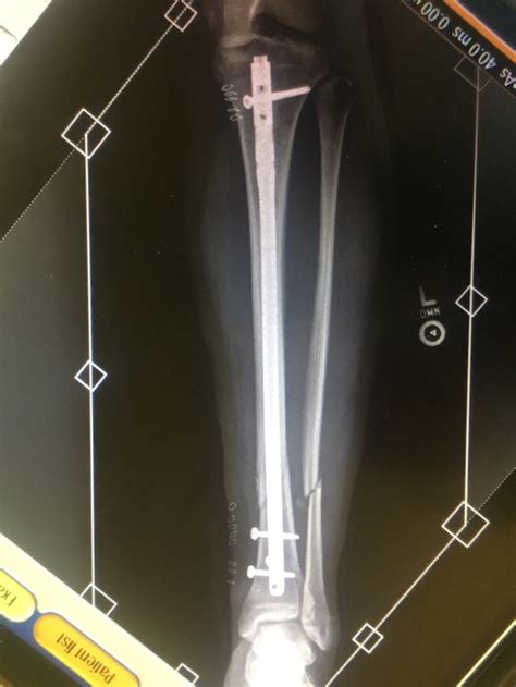 Compound Fracture Of Tibia And Fibula Recovery