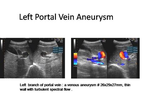 Portal Vein Ultrasound