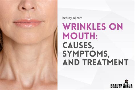 Wrinkles on Mouth: Causes, Symptoms, and Treatment - Beauty Ninja