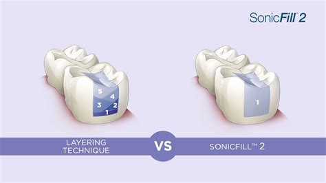 Comparing Bulk Fill Composites With Conventional Composite Materials