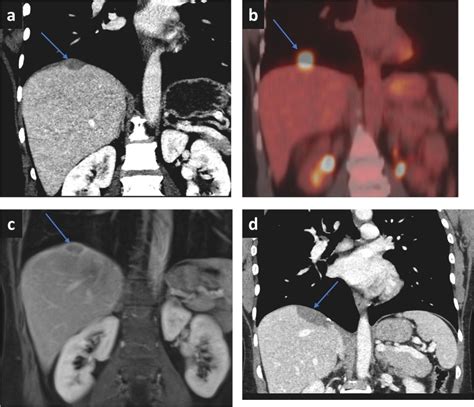 Primary Peritoneal Serous Carcinoma A Primer For Radiologists