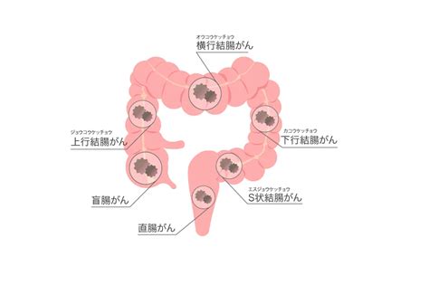 大腸がんの症状や原因は？｜堺なかむら総合クリニック