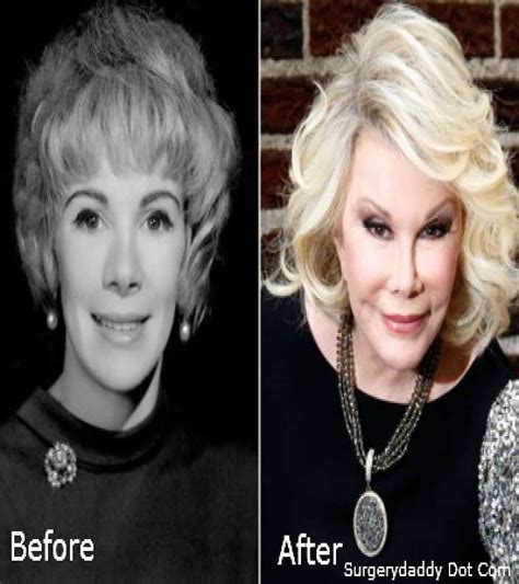 Worst Cases Of Celebrity Plastic Surgery Gone Wrong