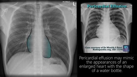 Radiograph Tutorial Chest X Ray Cxr Radiology Nation Youtube