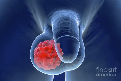 Testicular Cancer Photograph By Kateryna Kon Science Photo Library