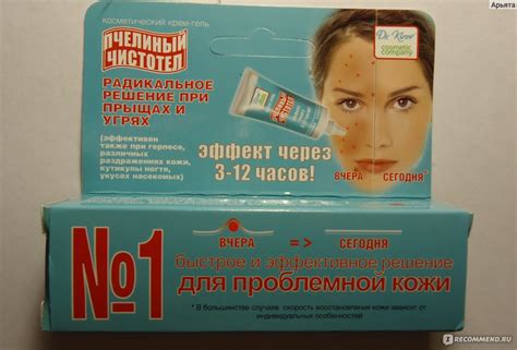 Мазь от прыщей на лице: обзор 20 популярных марок