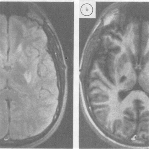 MRI scans in patient 8. There are lesions in the left internal capsule ...