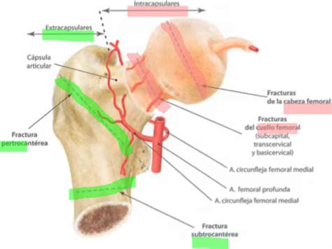 Fichas De Aprendizaje Fractura De Cadera Quizlet