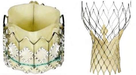 Medtronic Aortic Valve