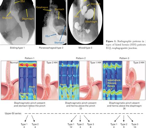 Figure 2 from Morphology of the Esophageal Hiatus: Is It Different in 3 ...