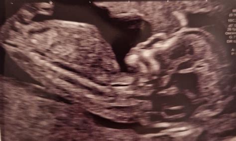 Week Scan Guess My Babys Sex Mumsnet