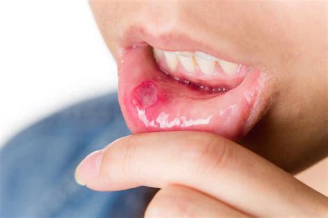 Recurrent Mouth Ulcers – Mark Osmond Dental Clinic