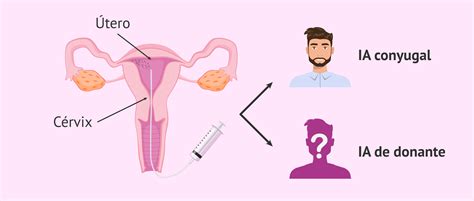 Procedimiento de la inseminación artificial intrauterina